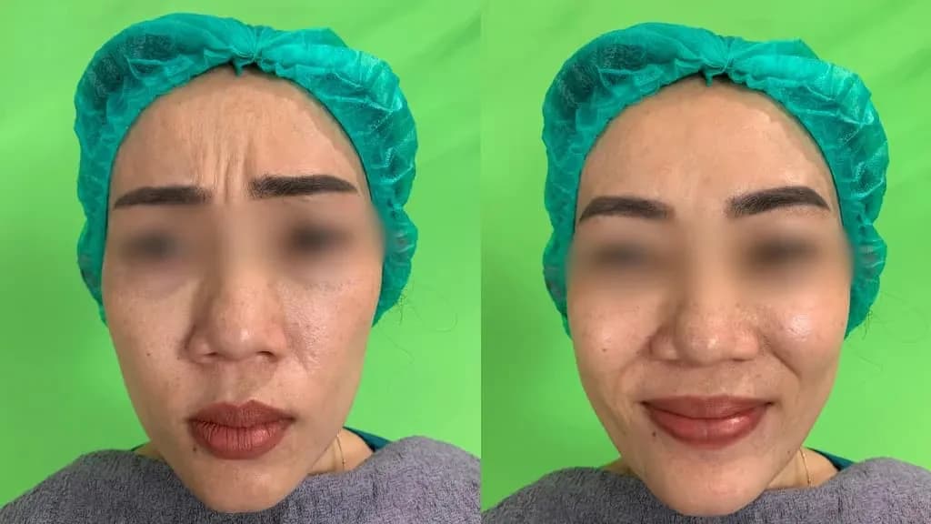 7 Cara Mengencangkan Pipi yang Kendur agar Tampak Awet Muda