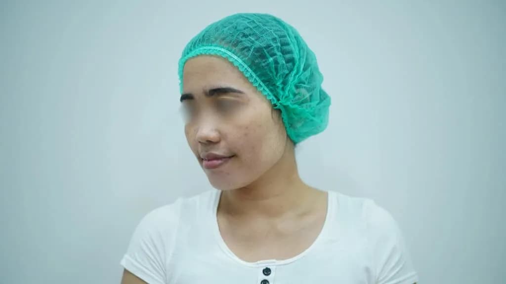 9 Cara Menghilangkan Bekas Jerawat yang Menghitam dengan Aman