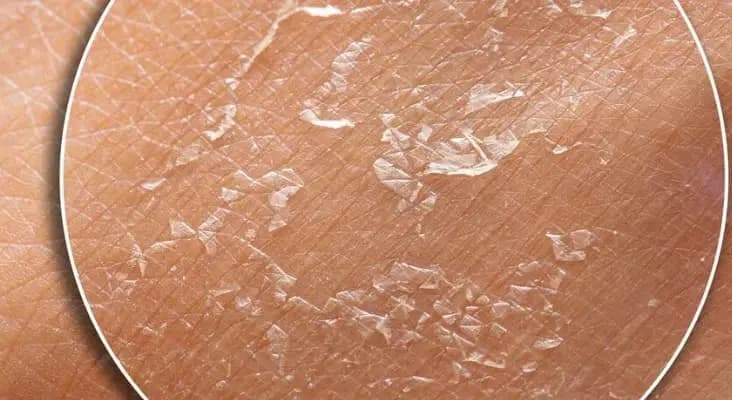 Kulit Mengelupas setelah Peeling Normal atau Tidak? Simak Jawabannya di Sini!