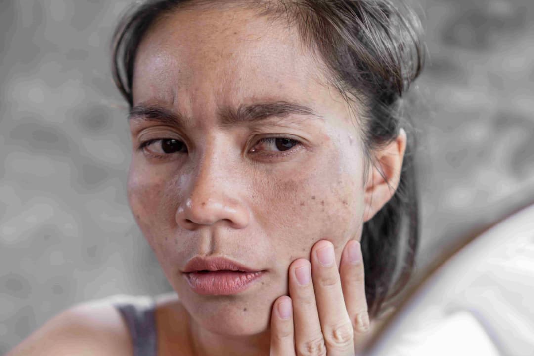 6 Perbedaan Melasma dan Flek Hitam serta Perawatannya