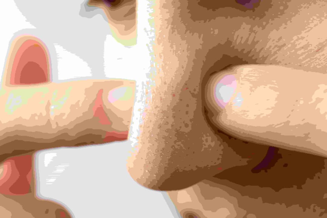 7 Penyebab Banyak Komedo di Muka dan Cara Mengatasinya