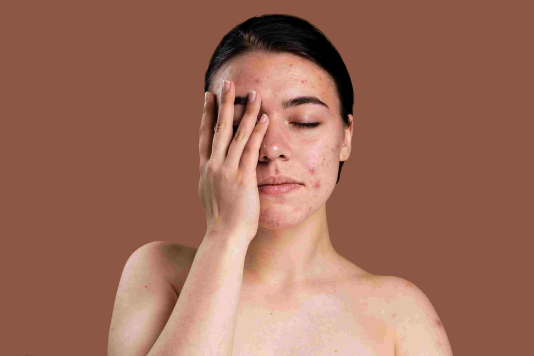 7 Cara Hilangkan Bruntusan di Hidung dengan Cepat dan Efektif