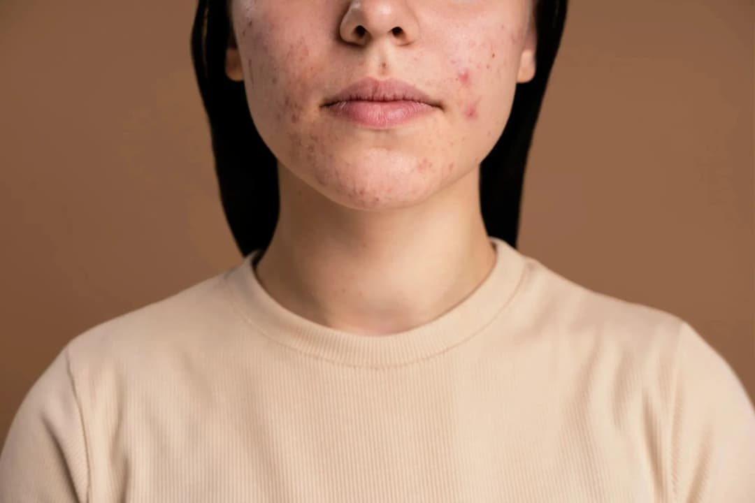 9 Cara Mengatasi Jerawat Hormonal agar Kulit Sehat Kembali