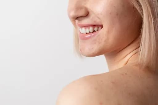 5 Perbedaan Fungal Acne dan Bruntusan, Penting Dipahami!