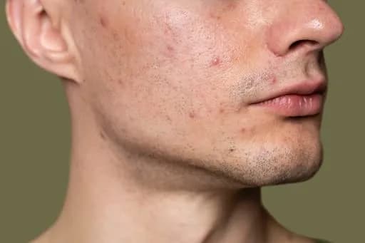 7 Cara Menghilangkan Bekas Jerawat Merah