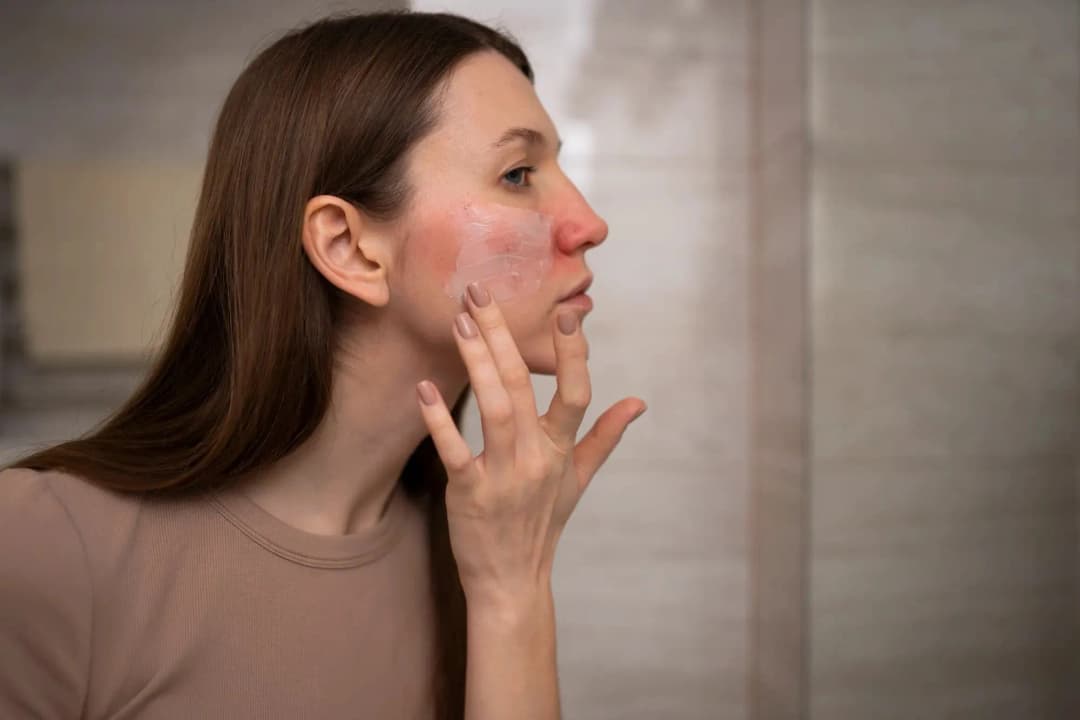 9 Cara Mengatasi Sunburn di Wajah secara Alami