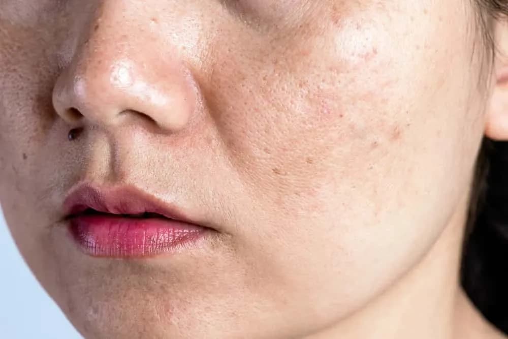 Cara Menghilangkan Dark Spot di Wajah agar Kulit Cerah Merata