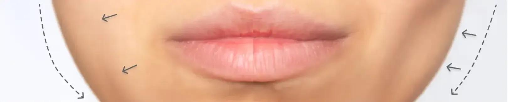Buccal Fat Removal