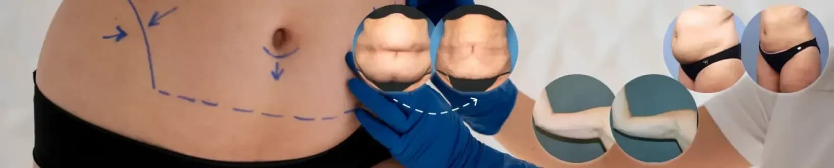 Lunch Time Liposuction
