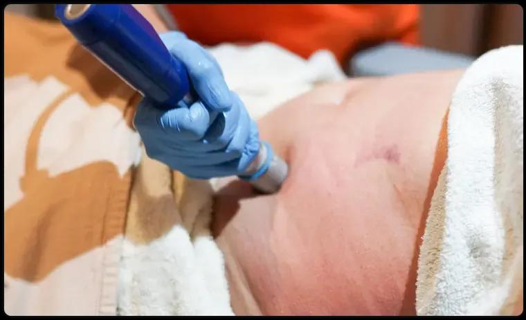 Cryolipolysis