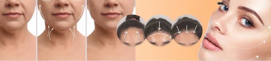 Face & Neck Lift