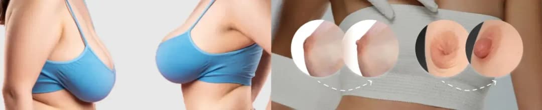 Nipple Correction