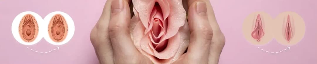 Labiaplasty