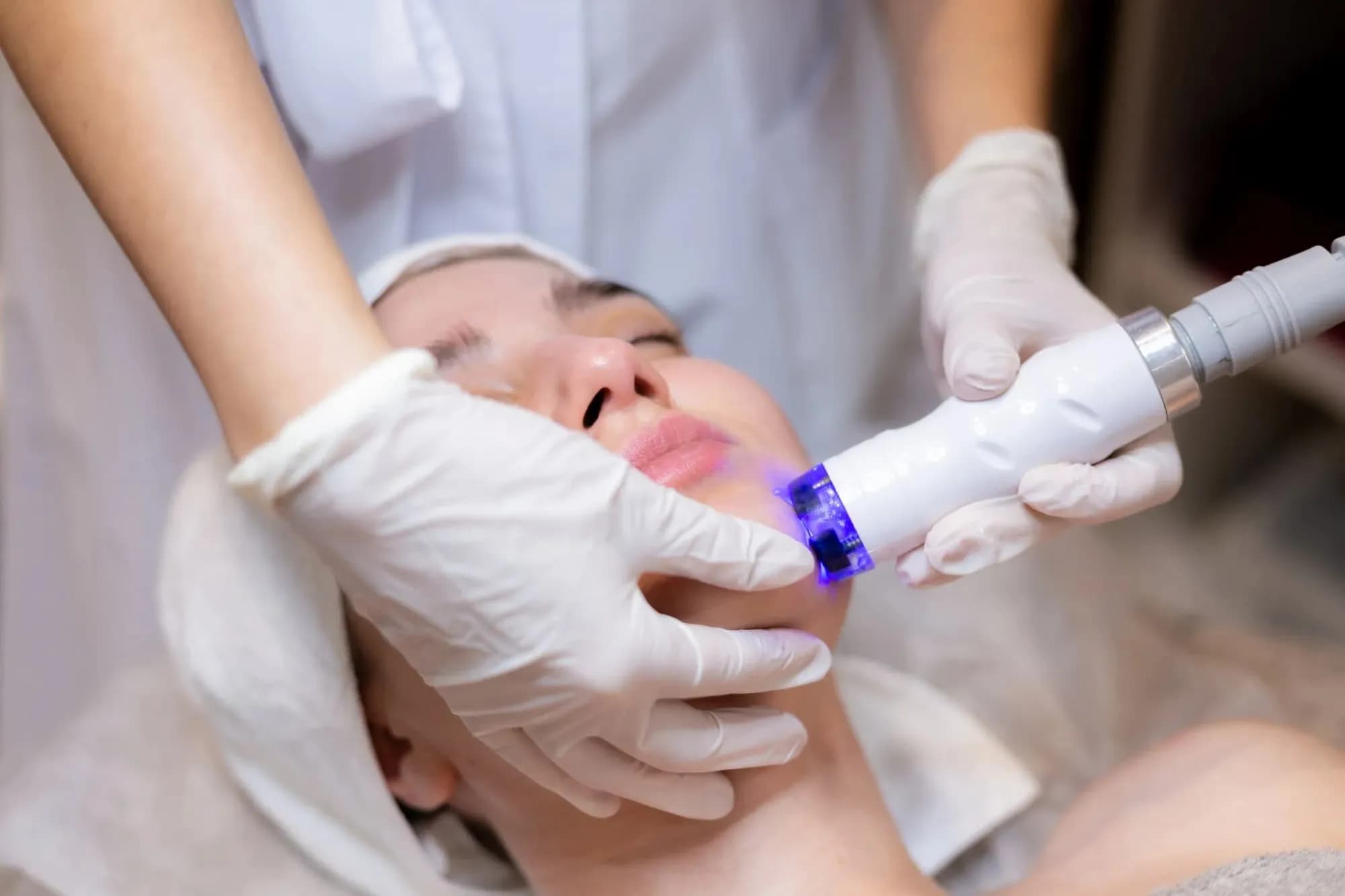 9 Pantangan Setelah Laser Wajah, Wajib Dihindari!