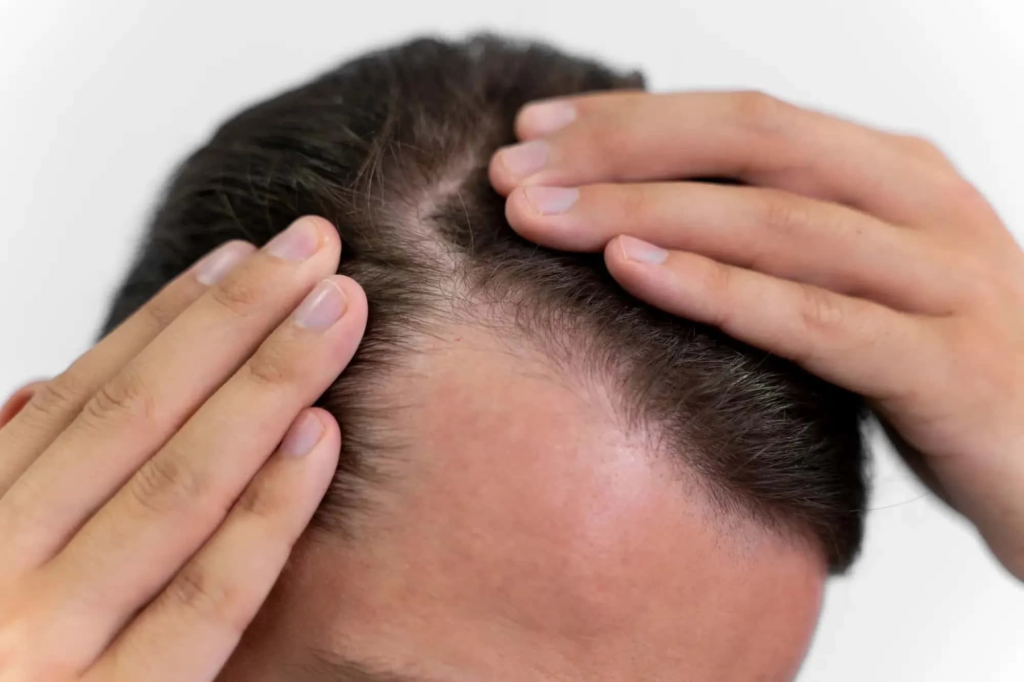Cara Mengatasi Rambut Rontok Parah Secara Alami dan Treatment 